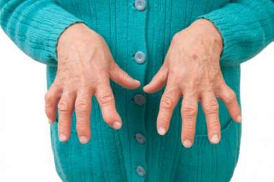 Conoce la nueva terapia para la artritis reumatoide
