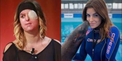 Concursante de Miss Italia fue desfigurada con ácido por su ex novio