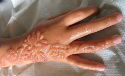 Tatuaje de henna causa graves quemaduras a niña