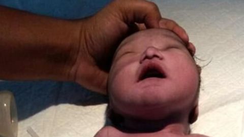 Muere "bebé sirena" cuatro horas después de nacer en India