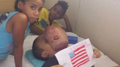 Muere niño cubano al que le extirparon en Miami un tumor facial de 4,5 kilos