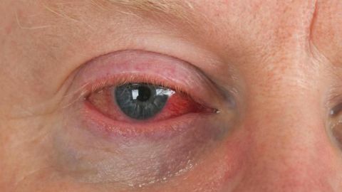 Conjuntivitis y herpes, enfermedades oculares más comunes en invierno