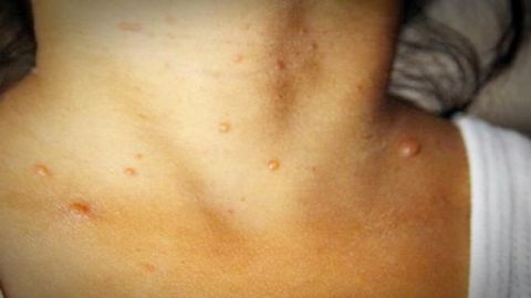 Aumenta en un 46 por ciento varicela en Yucatán
