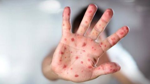 Brasil confirma 677 casos de sarampión, todos importados de Venezuela