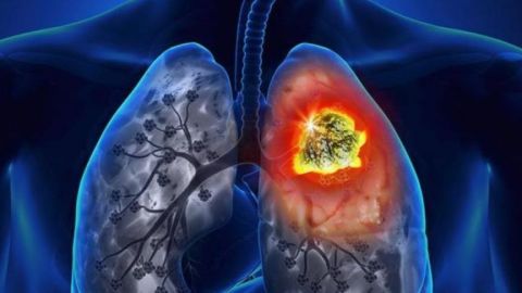 Solo uno de cada 10 pacientes con cáncer de pulmón en México puede curarse