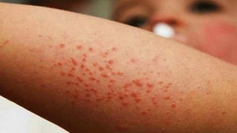 Declaran emergencia sanitaria en estado de Washington por brote de sarampión