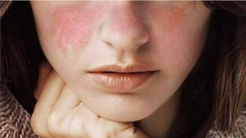 Famosos que luchan contra el Lupus, enfermedad sin cura