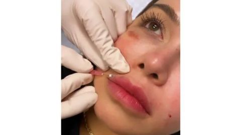 Chiquis Rivera se inyecta los labios y lo transmite en Instagram