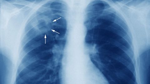 Aumentan casos de tuberculosis pulmonar a nivel mundial