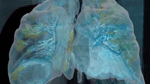VIDEO: Así se ve el daño del Covid-19 en los pulmones
