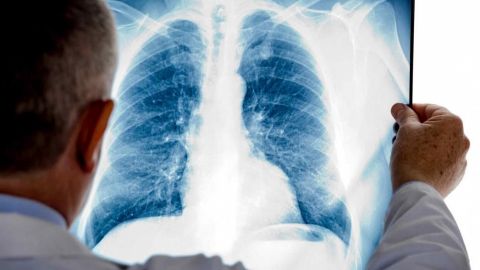 Tras sufrir fuerte tos, encuentran moneda en pulmón de hombre