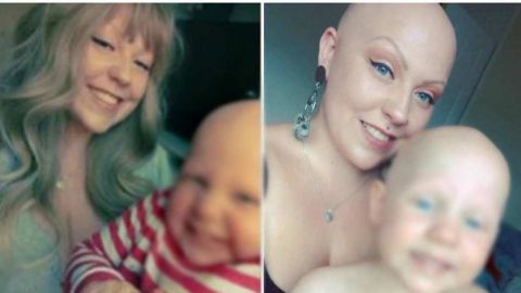 Madre e hija sufren alopecia; luchan contra los estereotipos compartiendo fotos