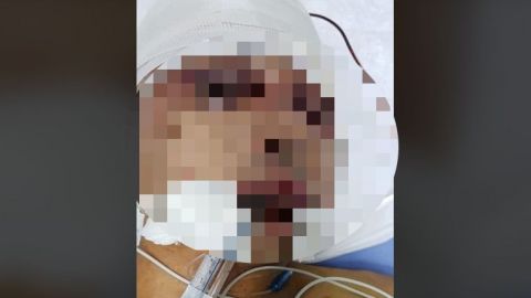 FUERTES IMÁGENES: Hombre desfigurado en hospital de Mexicali como desconocido