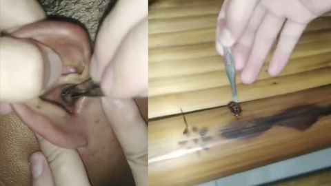VIDEO: Extraen cucaracha de la oreja de un hombre