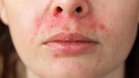 ¿El uso de cubrebocas te ha provocado acné? Así puedes tratarlo