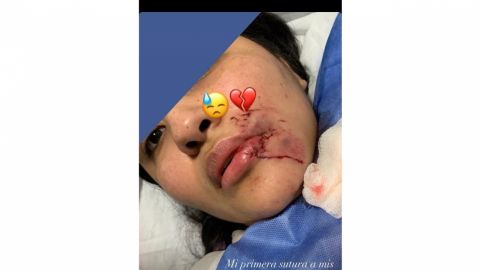 Joven es mordída en el rostro por su perro