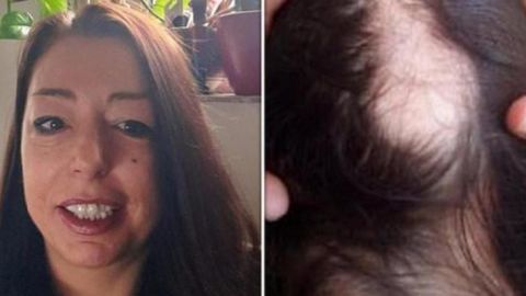 Mujer se entera que tuvo COVID-19 por su TERRIBLE pérdida de cabello