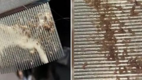 VIDEO VIRAL: Quitan los piojos a mujer tras ocho semanas de contagio