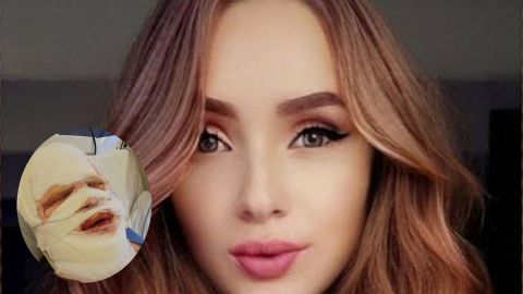 Exnovio la atacó con ácido en el rostro para después suicidarse