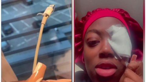 Cargador de teléfono explota y quema el ojo de una joven; video se hace viral