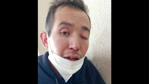 Fallece Gregorio, paciente con síntomas de 'hongo negro' en Estado de Mexico