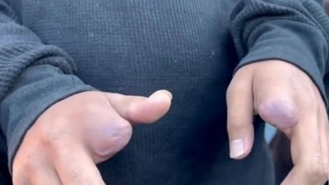Mutilan dedos a joven de 16 años tras negarse a vender droga
