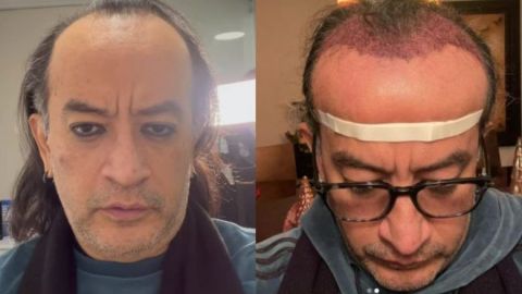 Genera críticas el injerto de cabello que se hizo Germán Ortega