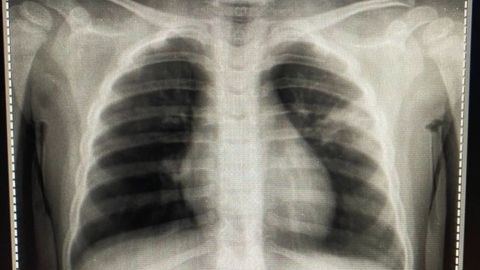 Doctor muestra daños pulmonares en niño de dos años tras padecer posible covid