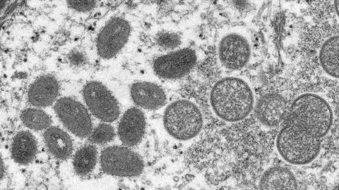 Sin necesidad inmediata de una vacunación masiva contra la viruela del mono: OMS