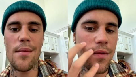 Justin Bieber revela que tiene la mitad del rostro paralizado