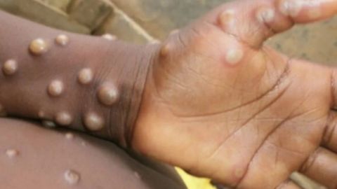 Suman más de 2 mil casos de viruela del mono en el mundo