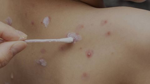 Casi mil casos de varicela en Baja California