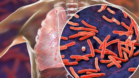 ¿Sabes los síntomas principales de la tuberculosis pulmonar?
