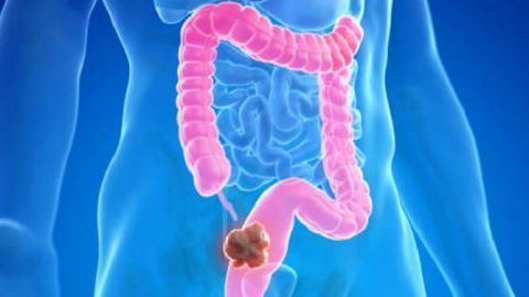 Cáncer de colon: Aconsejan exámenes desde 45 años