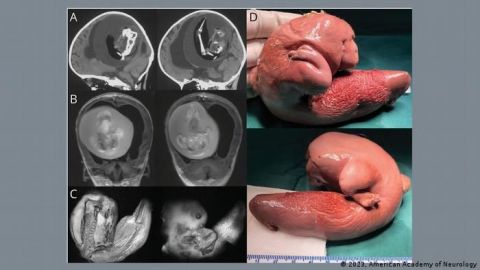 Feto en feto: médicos extraen 'gemelo parásito' del cerebro de una niña
