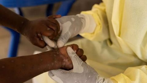 OMS levanta emergencia sanitaria por Mpox ante descenso de casos registrados