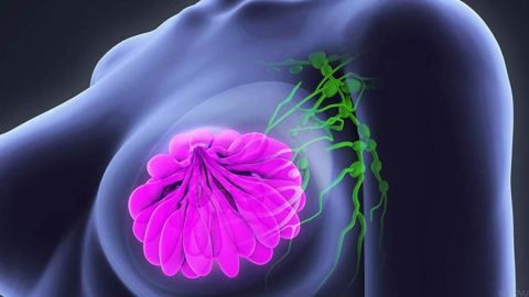 Cáncer de mama, principal causa de muerte en mujeres en México