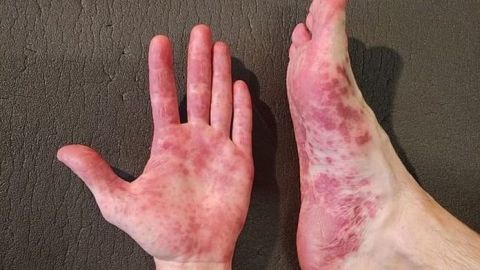 Suman 231 casos por virus Coxsackie en Baja California