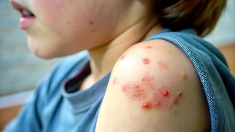 Baja California reporta 37 casos de sarampión y refuerza vacunación